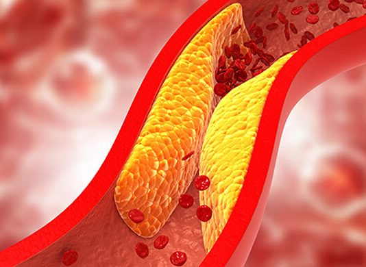 কোলেস্টেরল না ট্রাইগ্লিসারাইড কোনটি বেশি ক্ষতিকর?